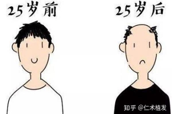 为什么会秃顶