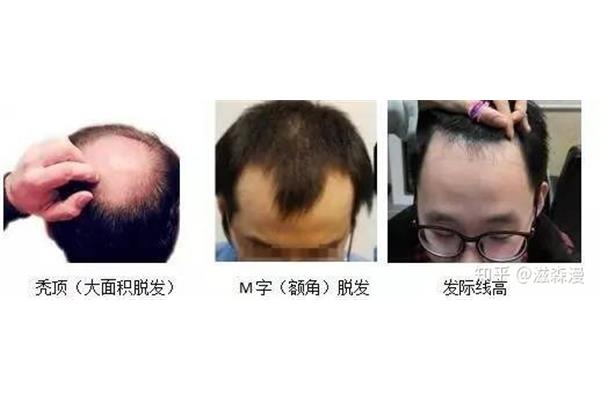 为什么会秃顶