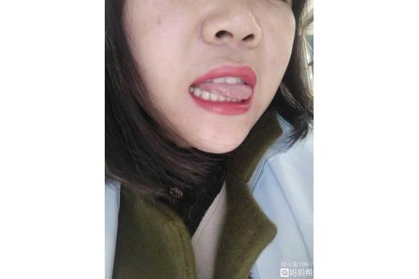 舌头侧面疼