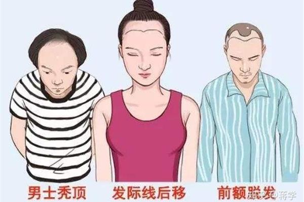 为什么会秃顶