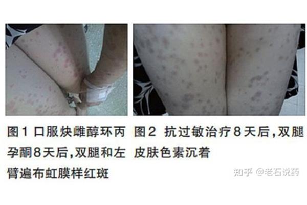药疹过敏图