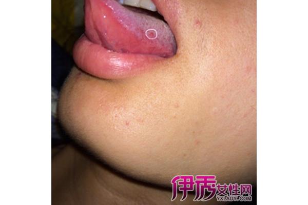 舌头侧面疼