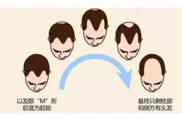 为什么会秃顶