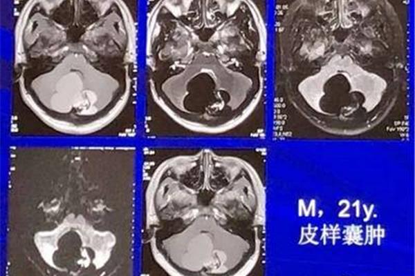 脑部核磁共振