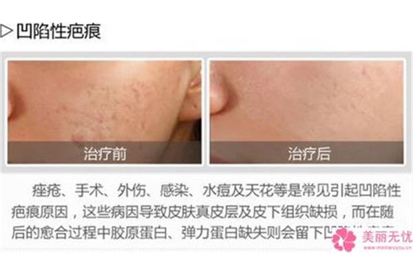 如何淡化疤痕