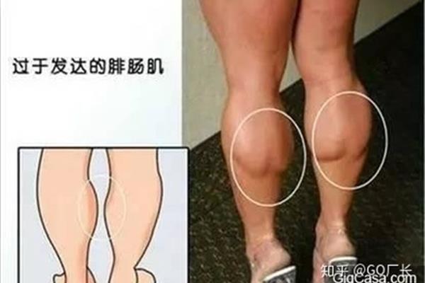 小腿粗壮的原因
