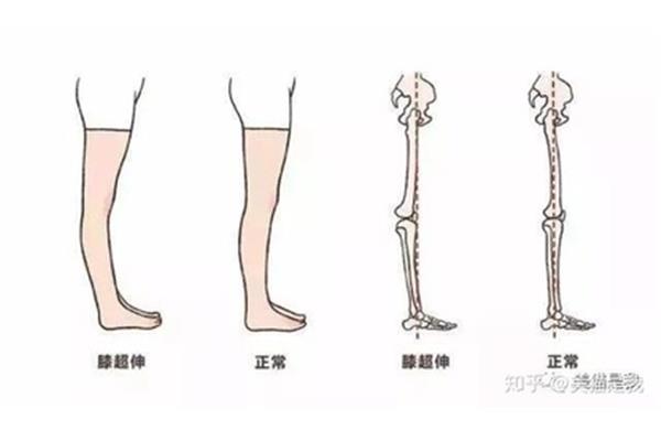 小腿粗壮的原因