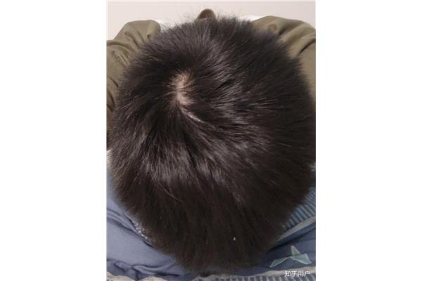 怎么让头发变粗