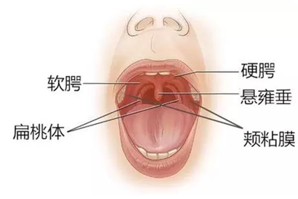 扁桃体溃疡图片