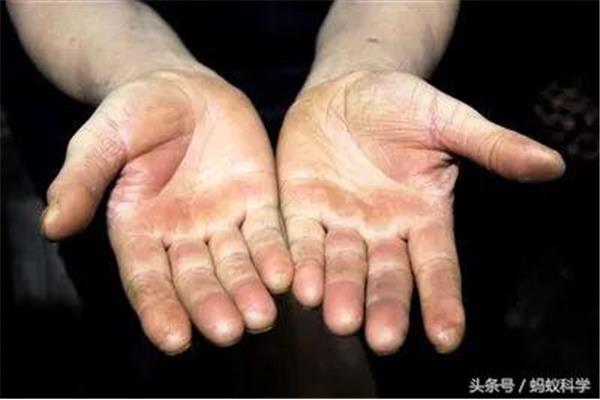 手上茧子怎么去除