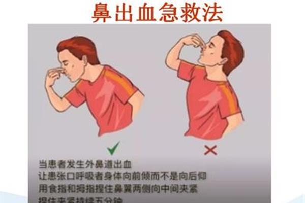 止鼻血的正确方法