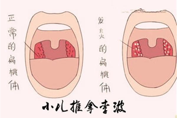 扁桃体溃疡图片