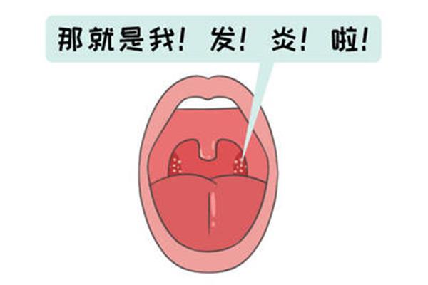 扁桃体溃疡图片