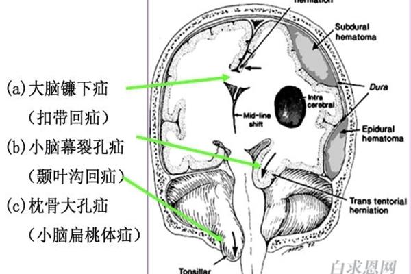脑疝的临床表现