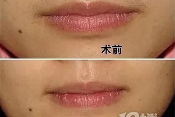 去唇毛的自然方法