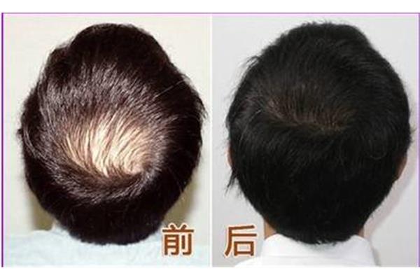 头发稀少怎么改善