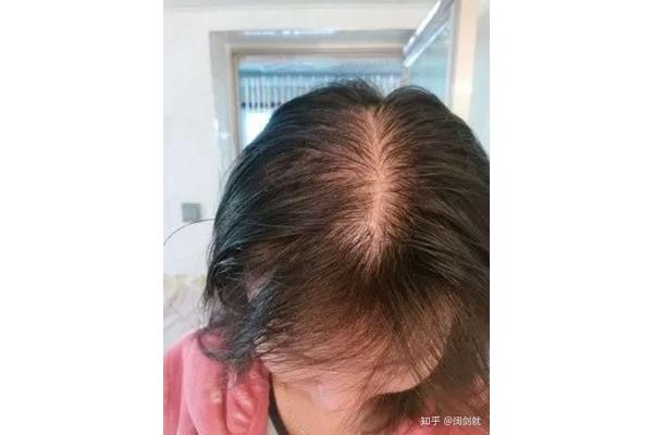 头发稀少怎么改善
