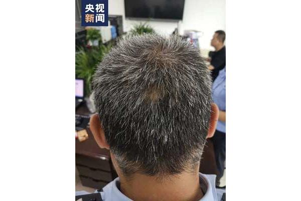 遗传性白发
