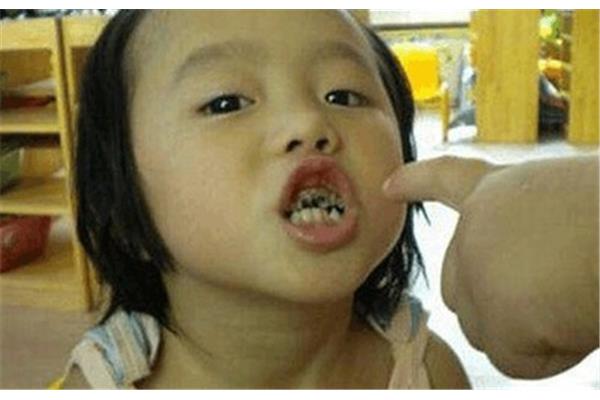 小孩蛀牙怎么办