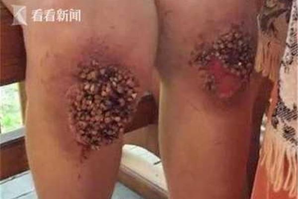皮开肉绽的意思