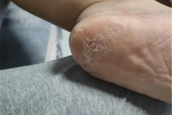 脚脱皮是怎么回事