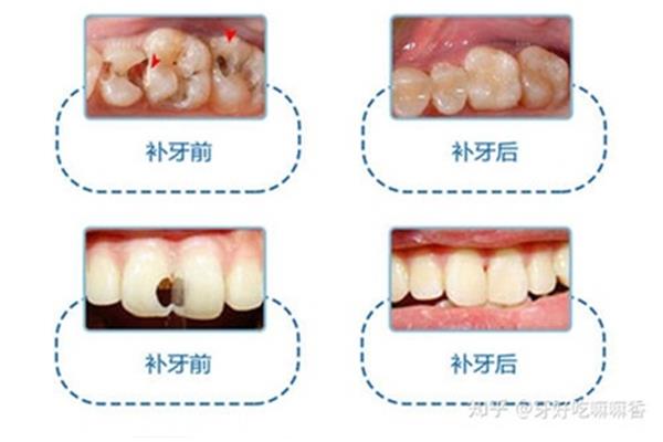 补牙要多长时间