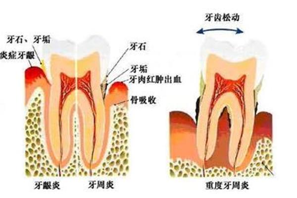 牙周炎治疗方法