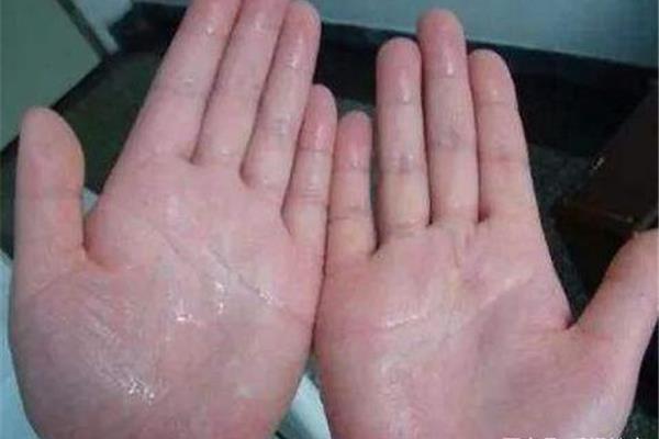 手脚心出汗