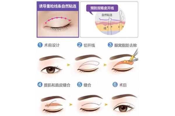 双眼皮切开法