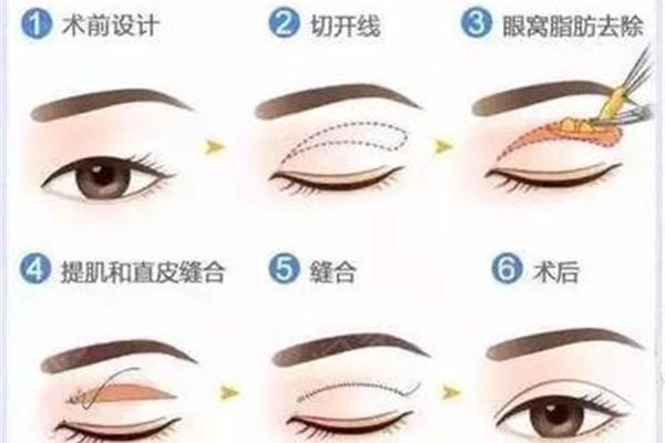 双眼皮切开法