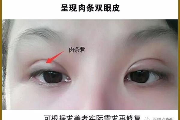 双眼皮切开法