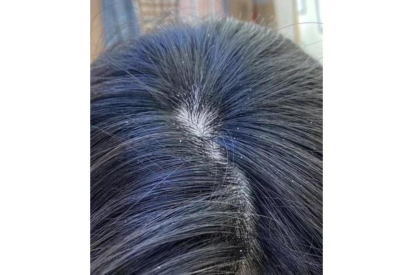 永久去屑的方法