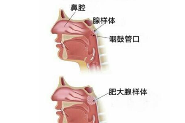 喉咙发炎会传染吗