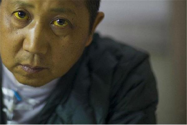 黄疸是什么病
