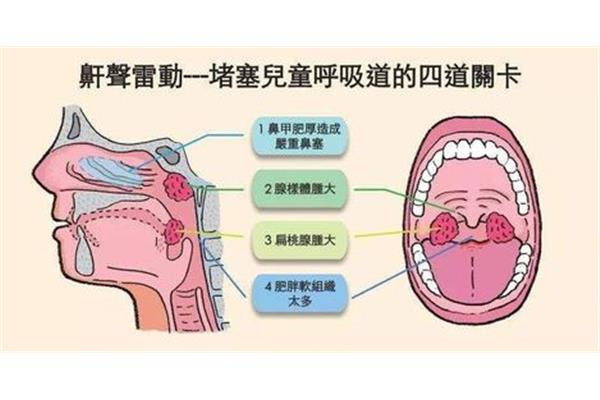 鼻甲肥大症状