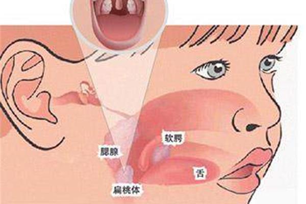 喉咙发炎会传染吗