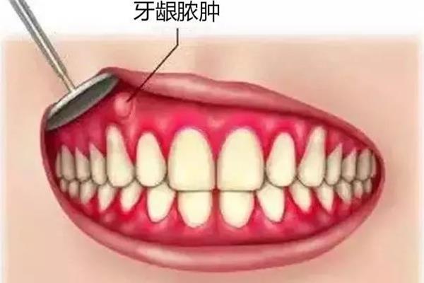 儿童牙龈长脓包