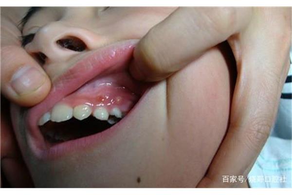 儿童牙龈长脓包