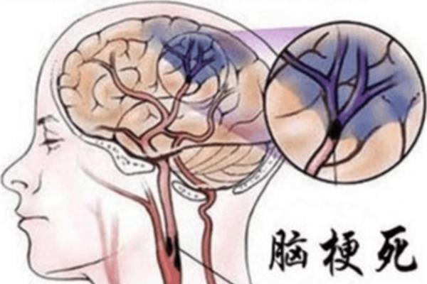 坏死的类型