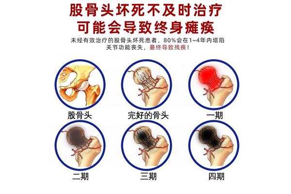坏死的类型