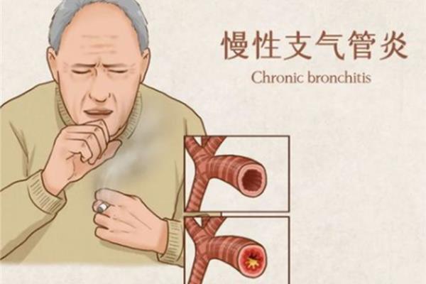 支气管炎中医