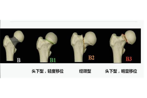 坏死的类型