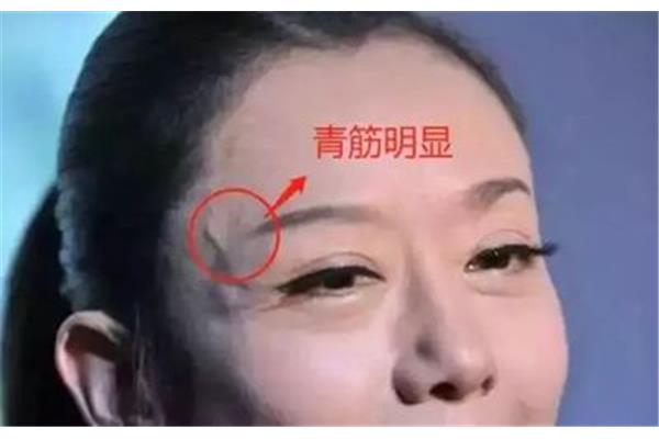 太阳穴有青筋