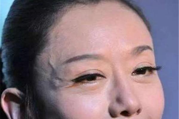 太阳穴有青筋