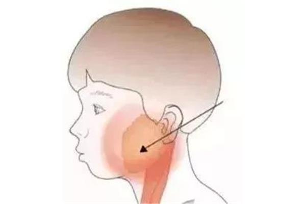 流行性腮腺炎症状