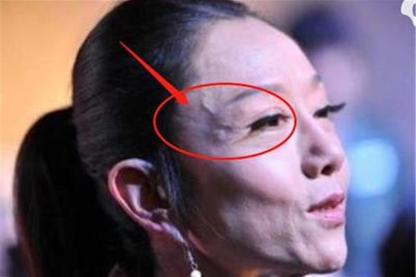 太阳穴有青筋