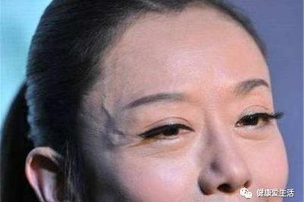 太阳穴有青筋