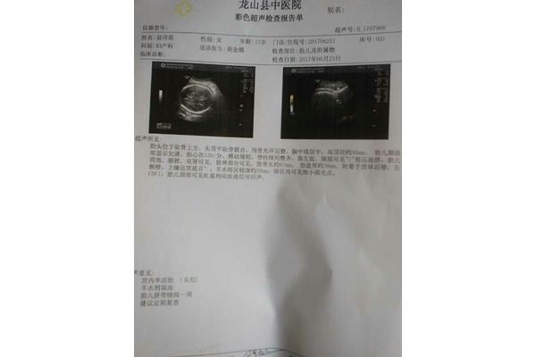 脐带绕颈怎么办
