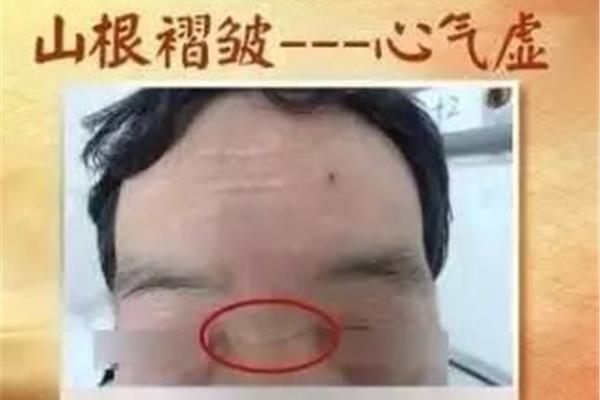 太阳穴有青筋