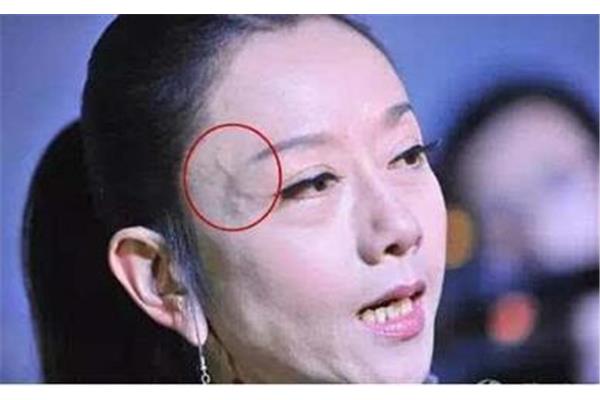太阳穴有青筋